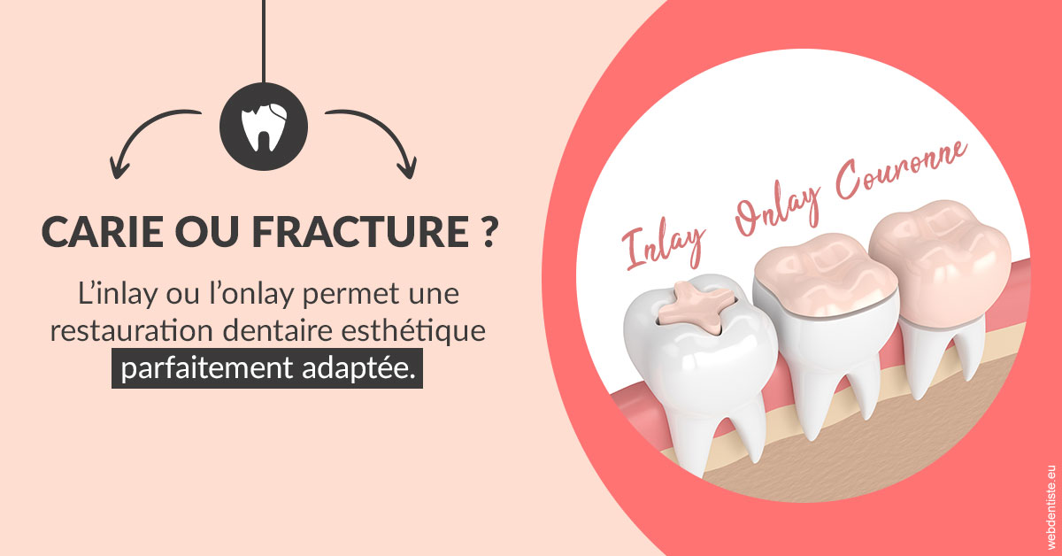 https://selarl-dr-leboeuf.chirurgiens-dentistes.fr/T2 2023 - Carie ou fracture 2