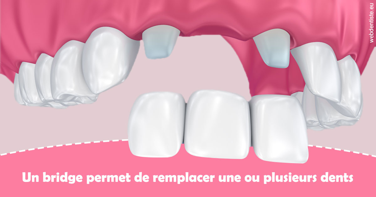 https://selarl-dr-leboeuf.chirurgiens-dentistes.fr/Bridge remplacer dents 2