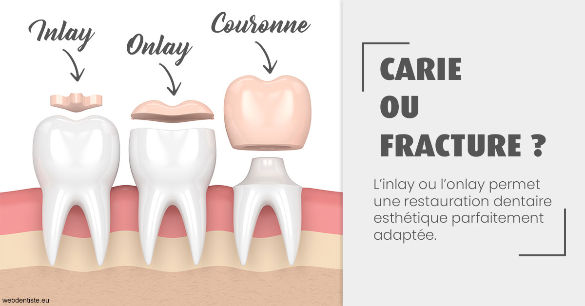 https://selarl-dr-leboeuf.chirurgiens-dentistes.fr/T2 2023 - Carie ou fracture 1