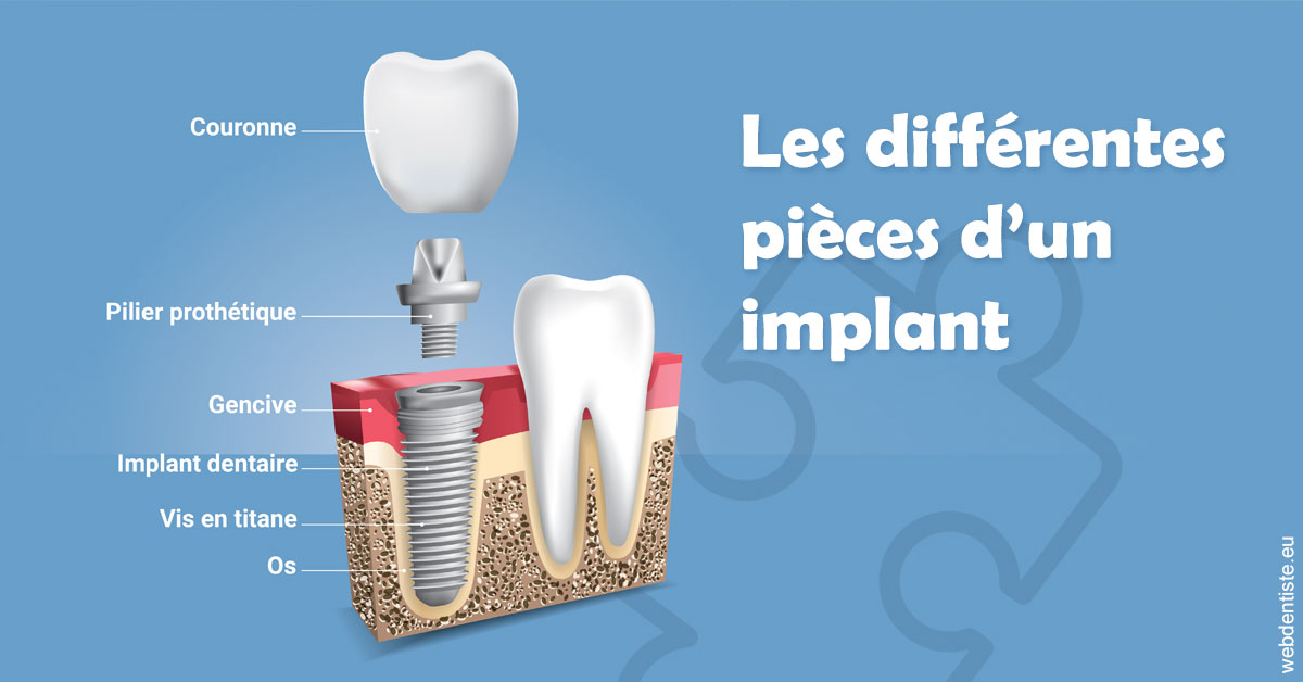https://selarl-dr-leboeuf.chirurgiens-dentistes.fr/Les différentes pièces d’un implant 1